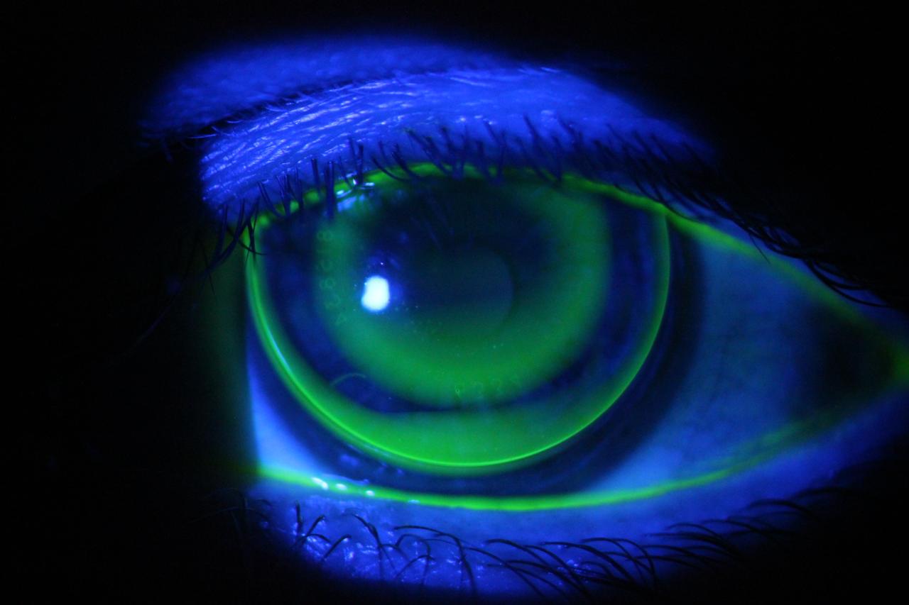 Orthokeratology (Ortho-K)