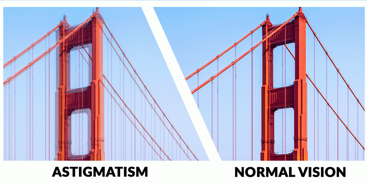Astigmatism2 Astigmatism2