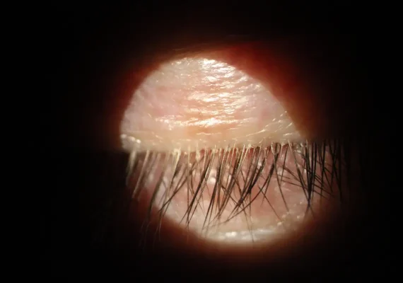 Demodex blepharitis
