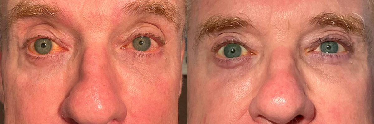 Envision_Lumecca & Forma_Cheeks_Before & After2 (1) Envision_Lumecca & Forma_Cheeks_Before & After2 (1)
