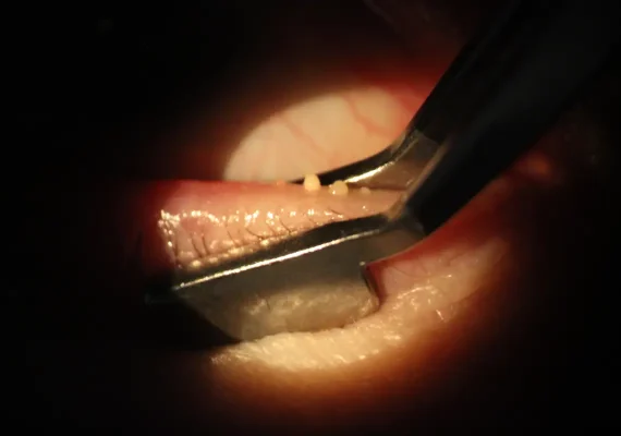 Meibomian gland dysfunction