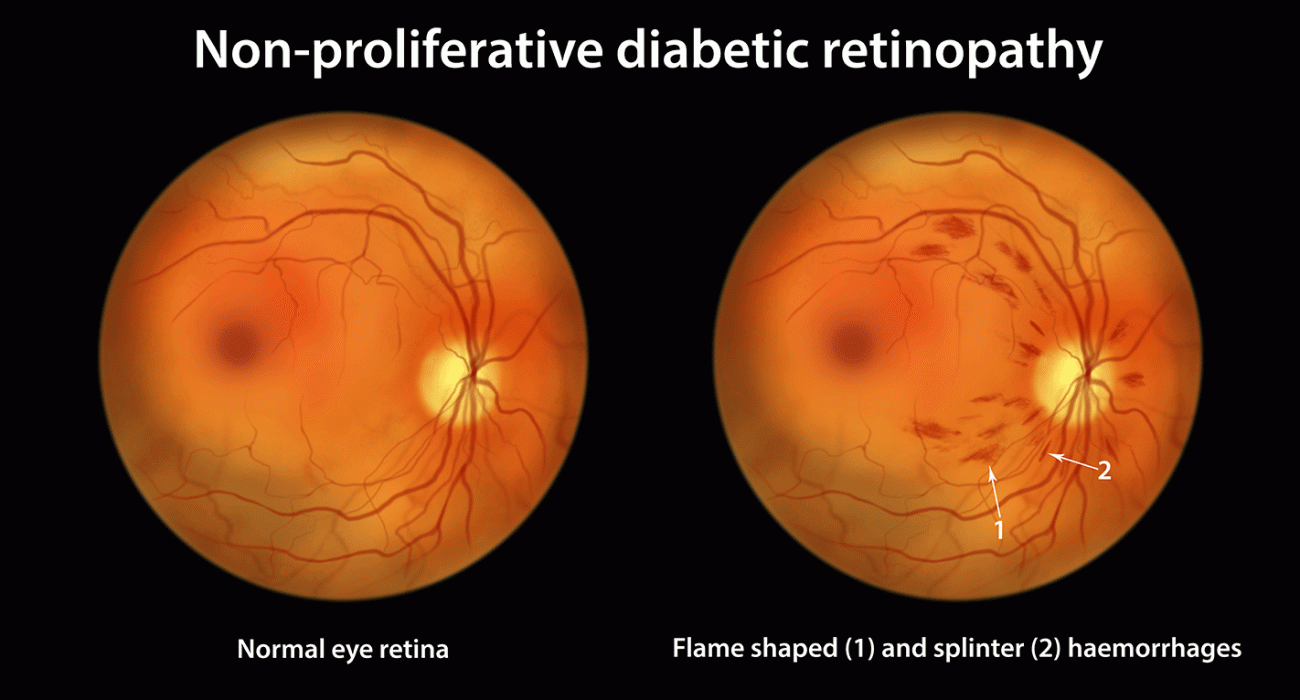 diabet-eye-exam diabet-eye-exam
